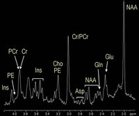 Magnetic resonance spectroscopy: The spectrum shows peaks for the following metabolic products: aspartate (Asp), glutamate (Glu), and glutamine (Gln).