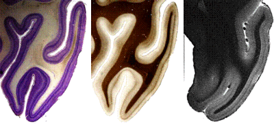 Vergleich zweier Histologiebildern (links und Mitte) mit einem MRT Bild (rechts).